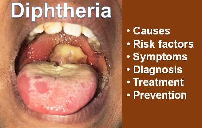 diphtheria